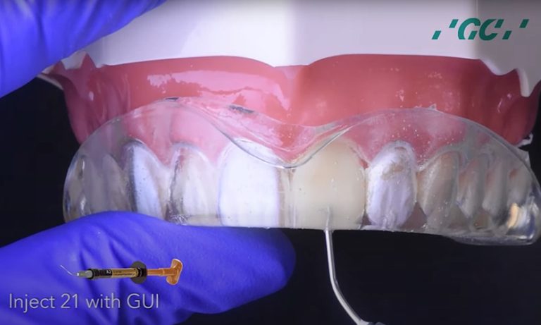 The Revolutionary Injection Molding Technique For Composite Veneers