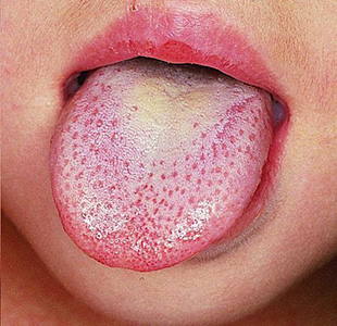 dehydration symptoms tongue