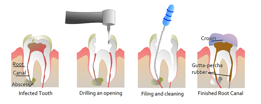 Microscope-Assisted Root Canals - What to Expect