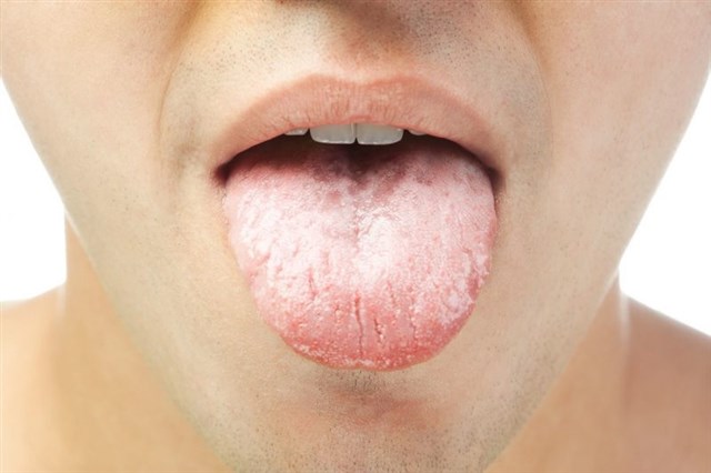 Dry Mouth Causes Symptoms Prevention And Treatment