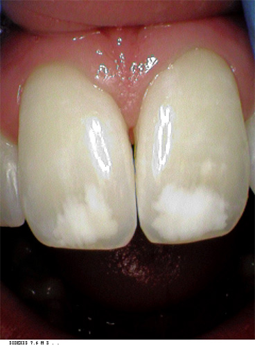Pittig Nu Definitie Removing White Spots on Teeth | St. Lawrence Dentistry