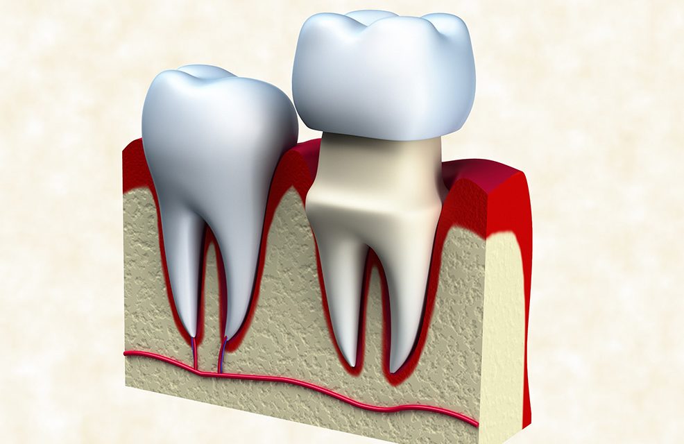 Root Canal Thru Crowns St. Lawrence Dentistry