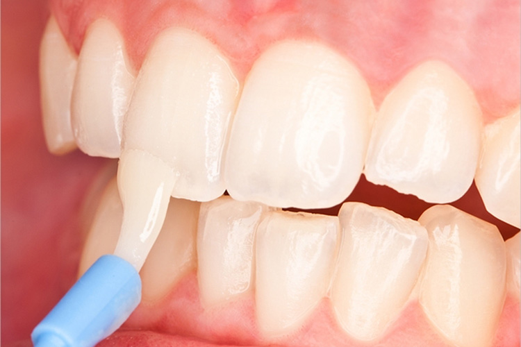 What Is Tooth Varnish