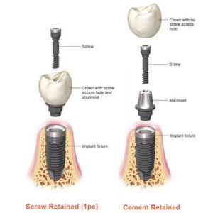 Creating A Great Crown For Your Dental Implant