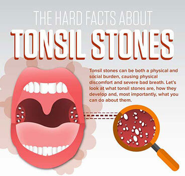 Tonsil Stones - DentalHealth